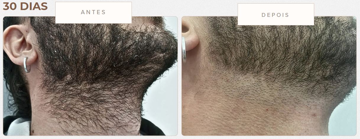Resultado antes e depois - Epilação a laser