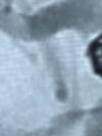 HCorBJ realiza procedimento de Embolização de Aneurisma Cerebral