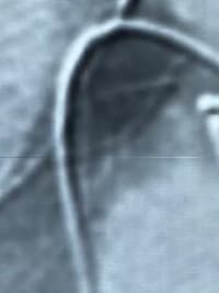 HCorBJ realiza procedimento de Embolização de Aneurisma Cerebral