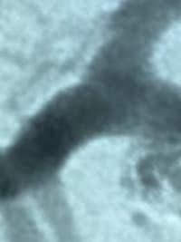 HCorBJ realiza procedimento de Embolização de Aneurisma Cerebral