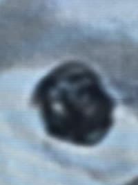 HCorBJ realiza procedimento de Embolização de Aneurisma Cerebral