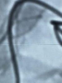 HCorBJ realiza procedimento de Embolização de Aneurisma Cerebral