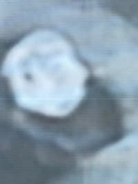 HCorBJ realiza procedimento de Embolização de Aneurisma Cerebral