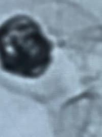 HCorBJ realiza procedimento de Embolização de Aneurisma Cerebral