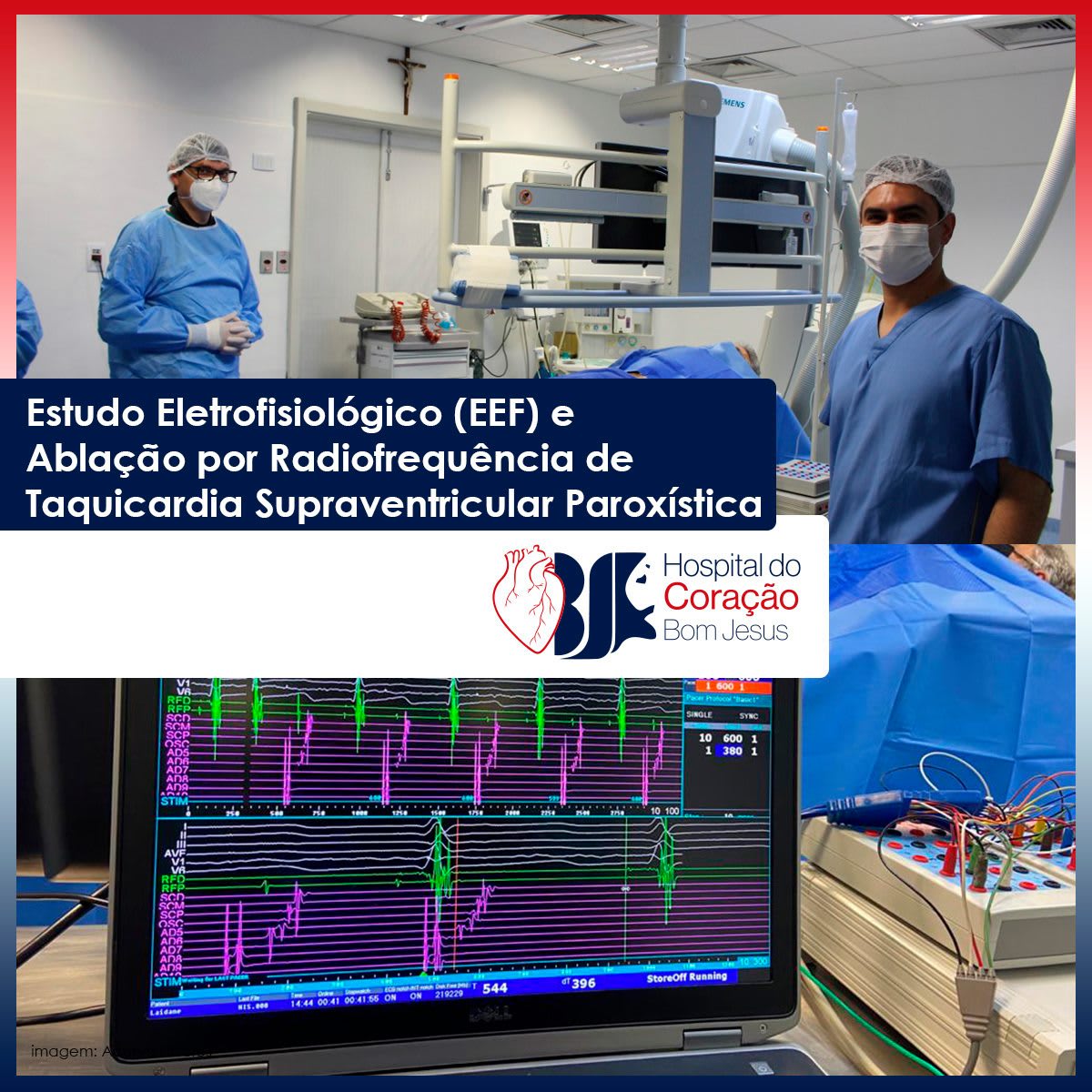 Estudo Eletrofisiológico (EEF) e Ablação por Radiofrequência de Taquicardia Supraventricular Paroxística no HCorBJ 