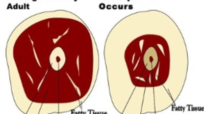 Sarcopenia