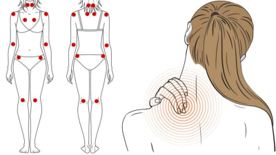 Fibromialgia