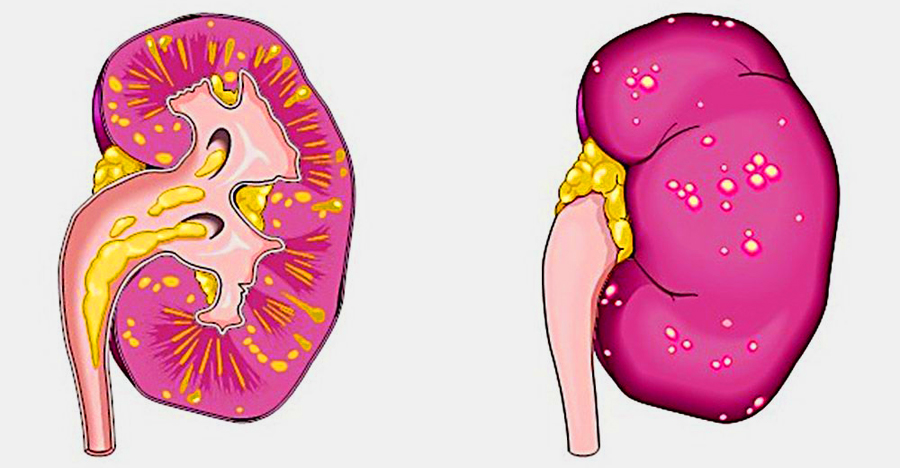 Пиелонефрит карта вызова смп