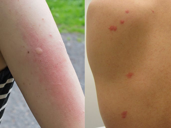 Bed Bug Bites vs Mosquito Bites: How to Tell the Difference | Pest Guard