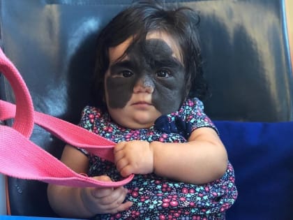 Девочка с «маской Бэтмена» прилетела из США в Краснодар на лечение