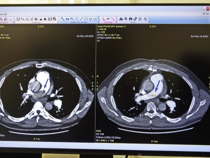 Кардиохирурги Сургута спасли пациента с огромным тромбом, которые препятствовал дыханию