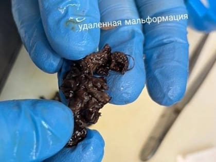 Врачи Югорска спасли пациента с огромной внутримозговой гематомой