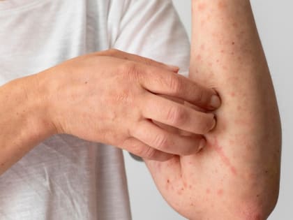 Возможный случай кори в Нижневартовске: диагноз еще не подтвержден