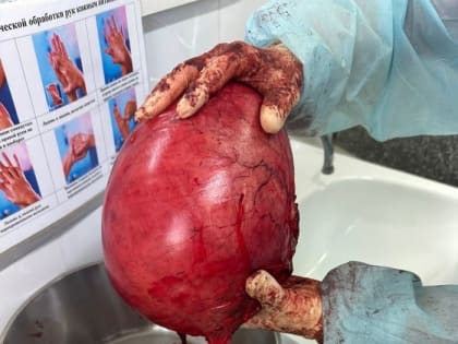 Сургутские гинекологи удалили четырехкилограммовую миому