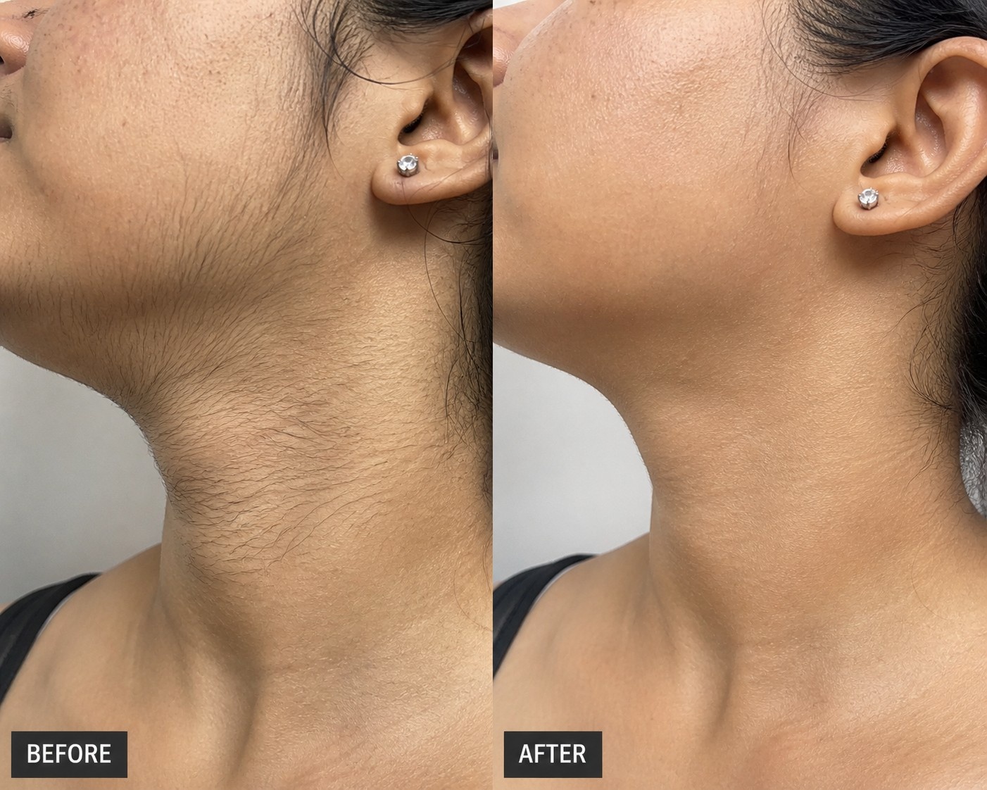 Laser Hair Removal