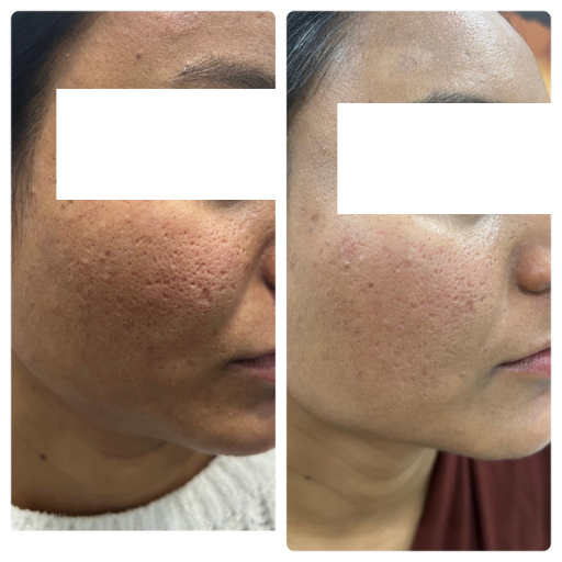 Acne Scars