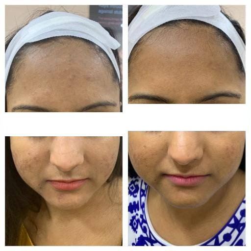 Acne & Acne Scar Treatment 1