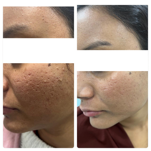 Acne & Acne Scar Treatment 2