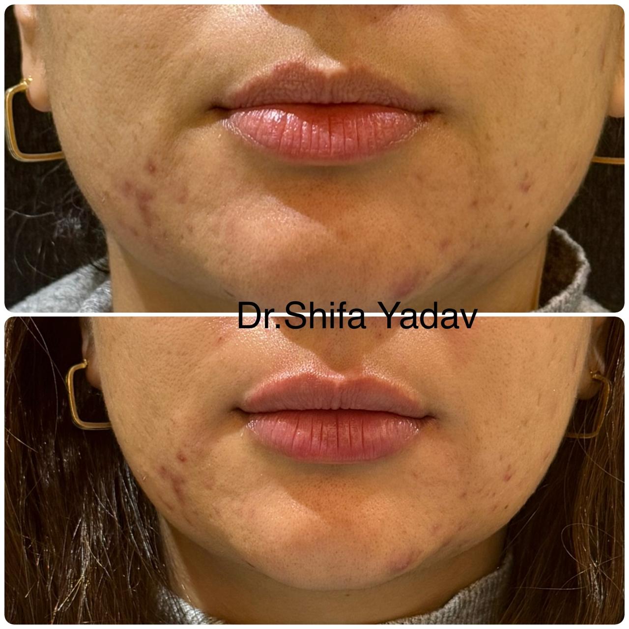 Lip Fillers
