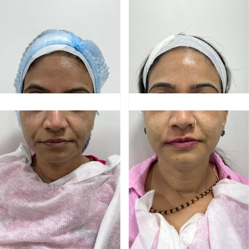 Full Face Rejuvenation