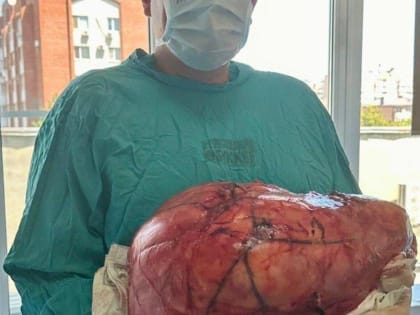 Успешное удаление 17-килограммовой опухоли в Краснодаре