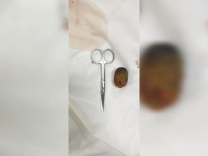 Краснодарские хирурги удалили огромный камень пожилой пациентке с ожирением