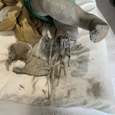 During Treatment- Showing concrete fill of legs