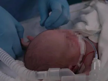 Пациенту всего лишь 16 дней: двухнедельного младенца с врожденным пороком сердца спасли от смерти иркутские хирурги