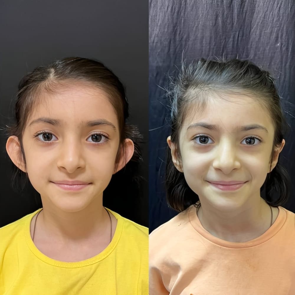 Ear Reshaping (Otoplasty) at Regenera, Indore