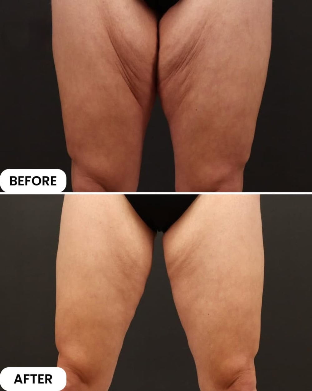 Body Contouring & Liposuction at Regenera, Indore