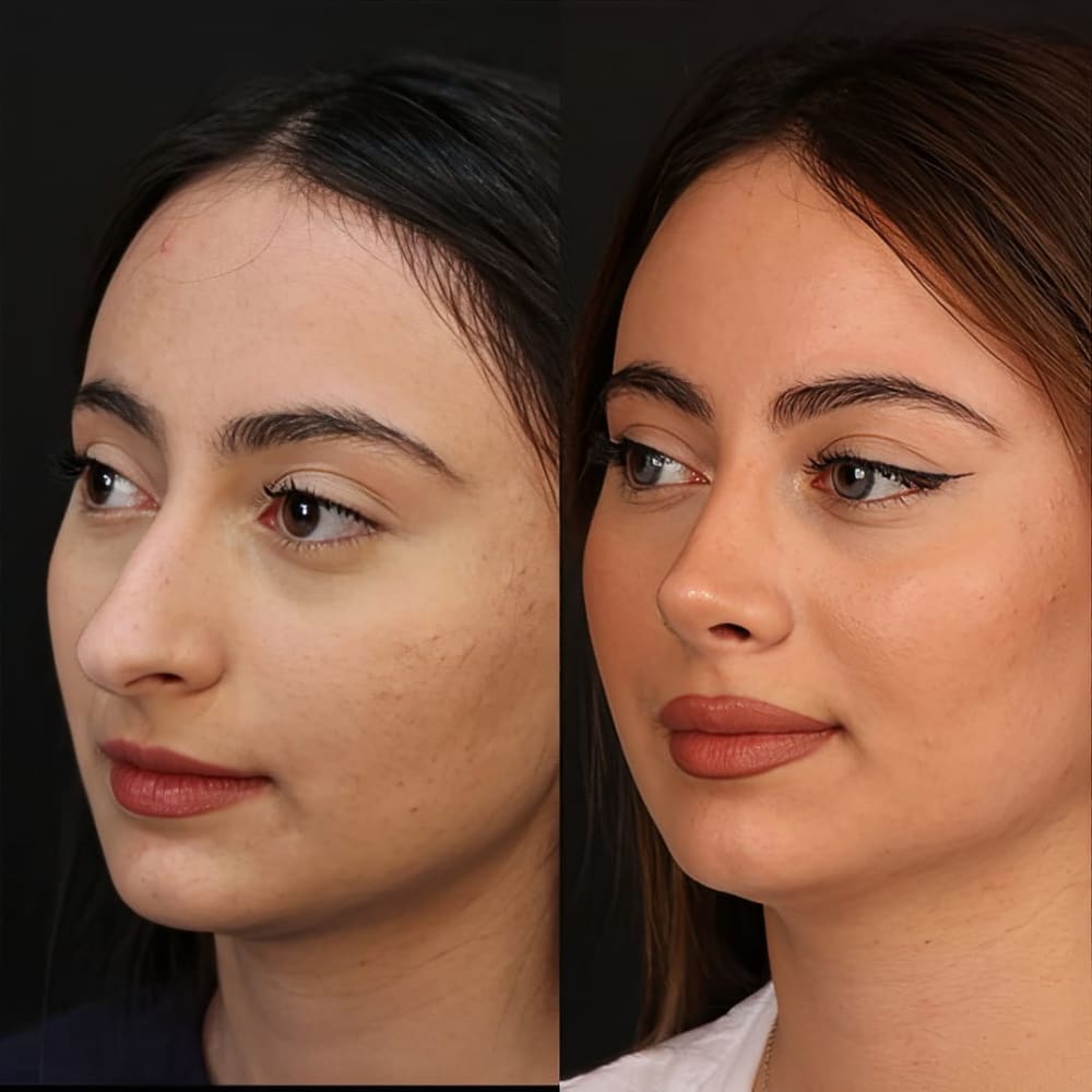 Rhinoplasty (Nose Reshaping) at Regenera, Indore