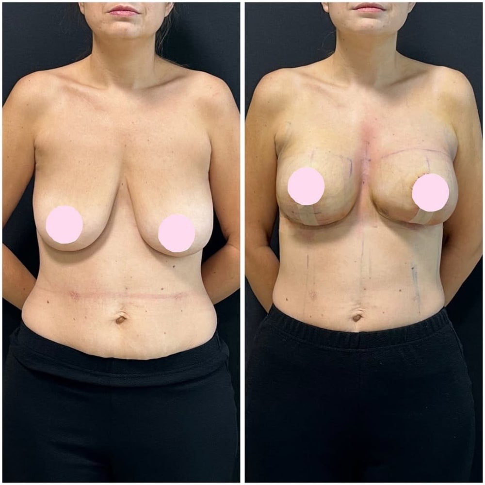 Breast Surgery at Regenera, Indore