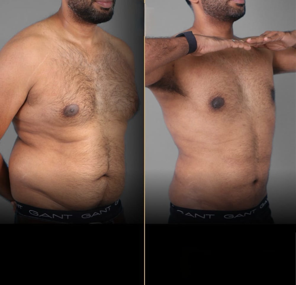 Gynaecomastia Surgery at Regenera, Indore