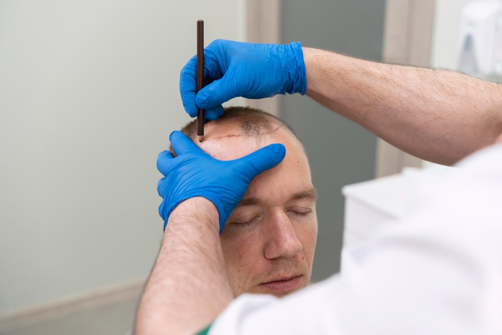 Hair Transplant & Restoration at Regenera, Indore