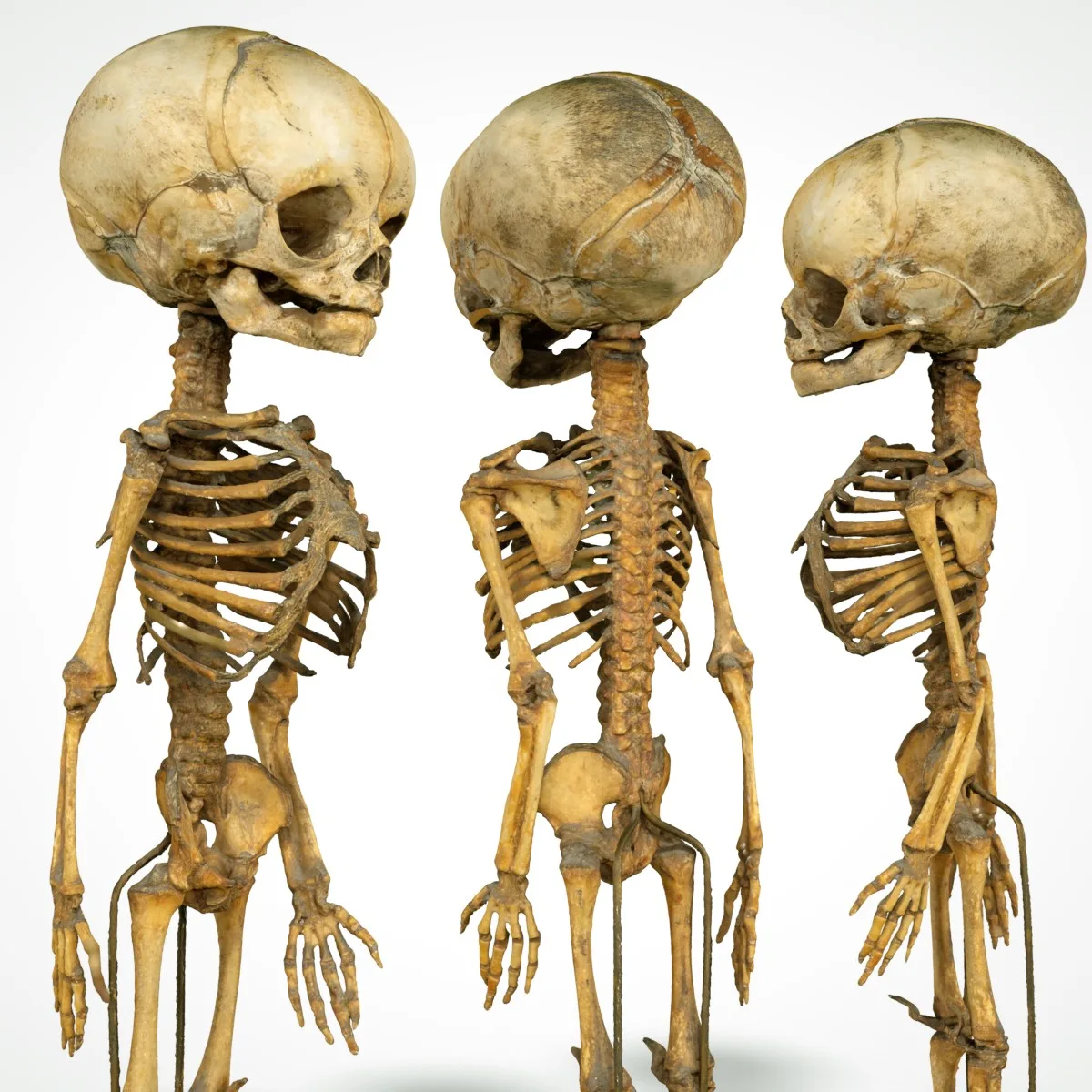 Unborn Human Baby Foetus Skeleton