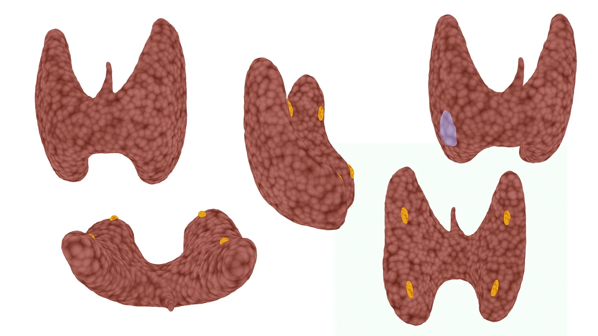 Healthy Thyroid and Thyroid Cancer