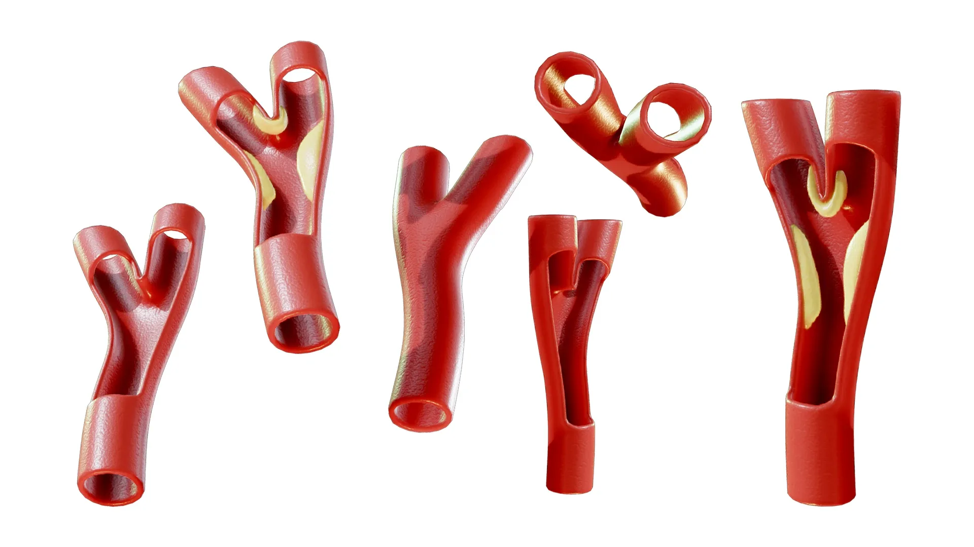 Peripheral Artery Disease