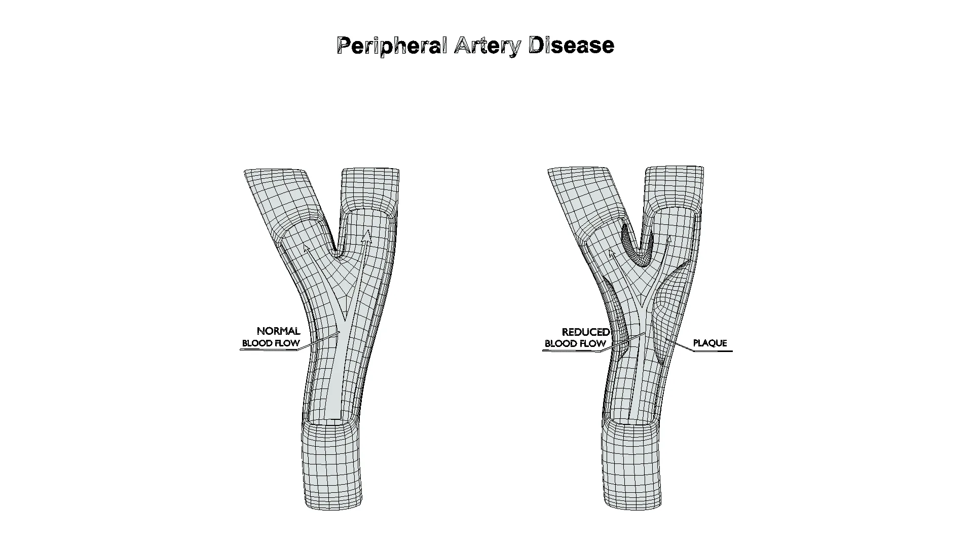 Peripheral Artery Disease