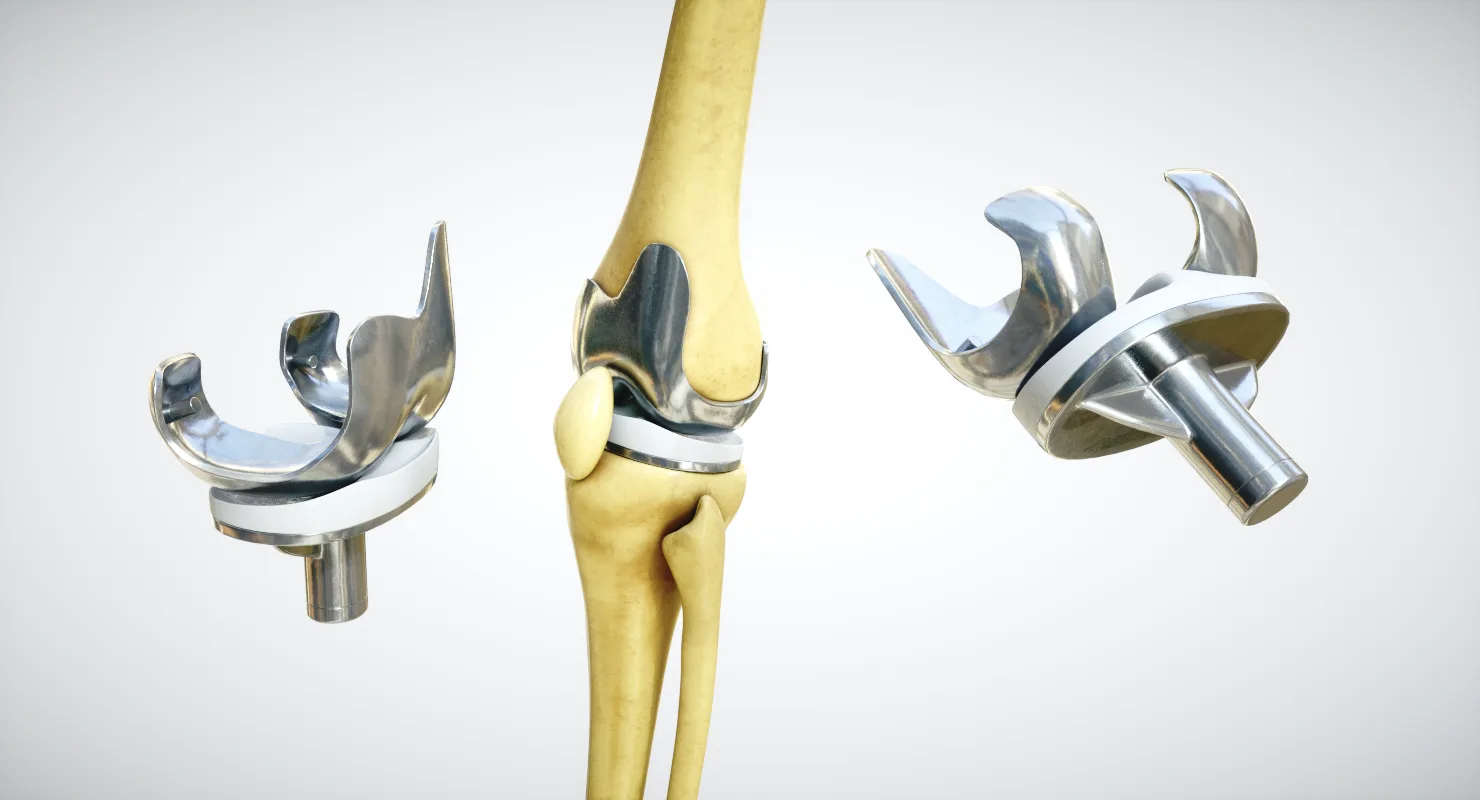 Knee Endoprosthesis