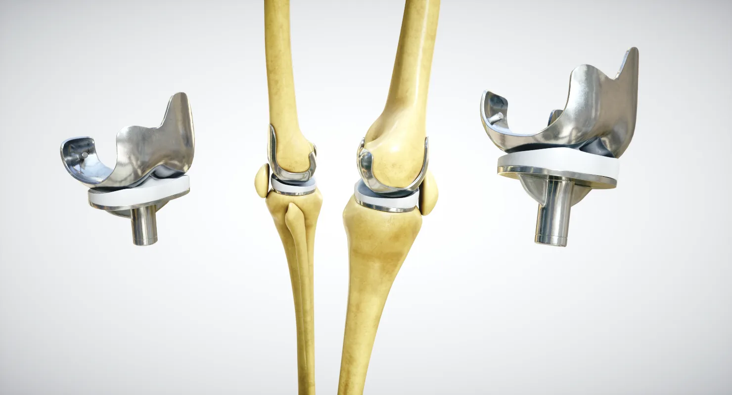 Knee Endoprosthesis