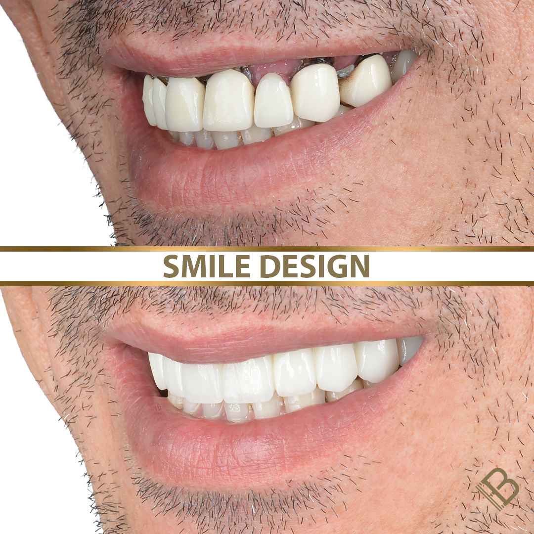 Diseño de Sonrisa