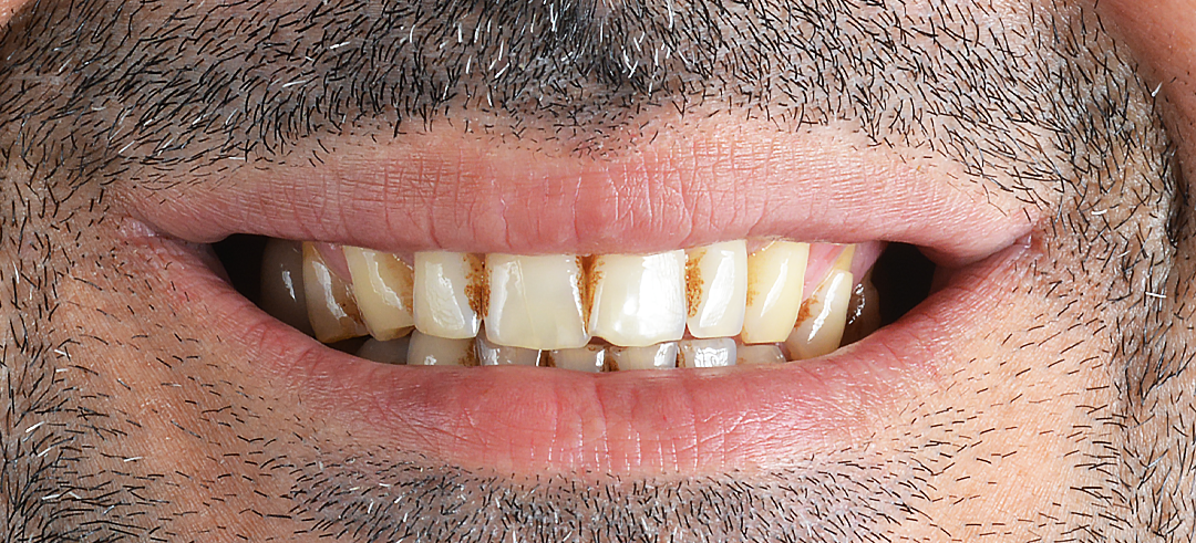 Antes Diseño de Sonrisa
