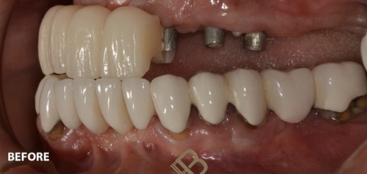 Antes Implante Dental