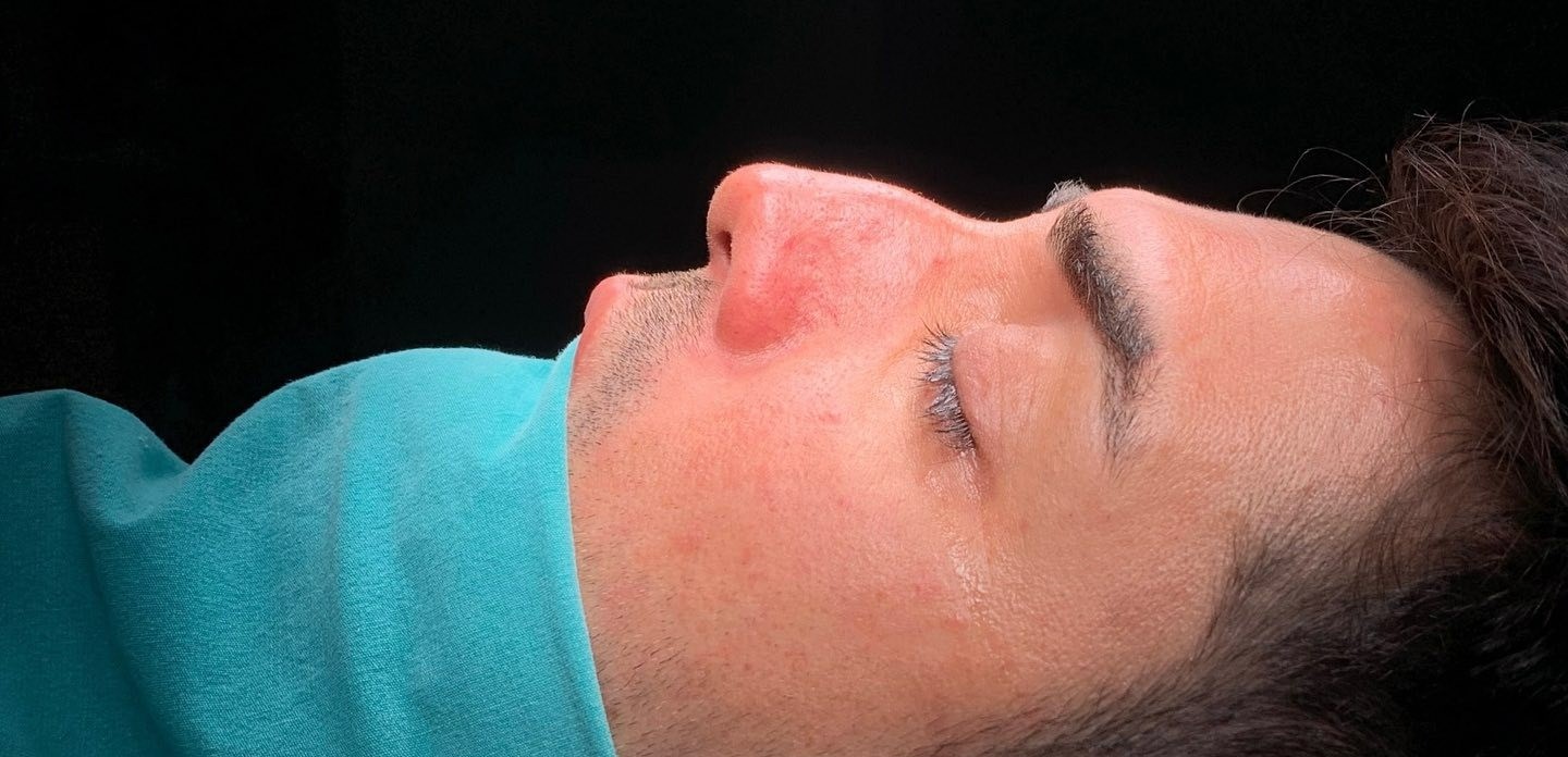 Antes Rinoplastia