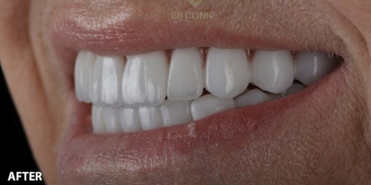 Después Implante Dental