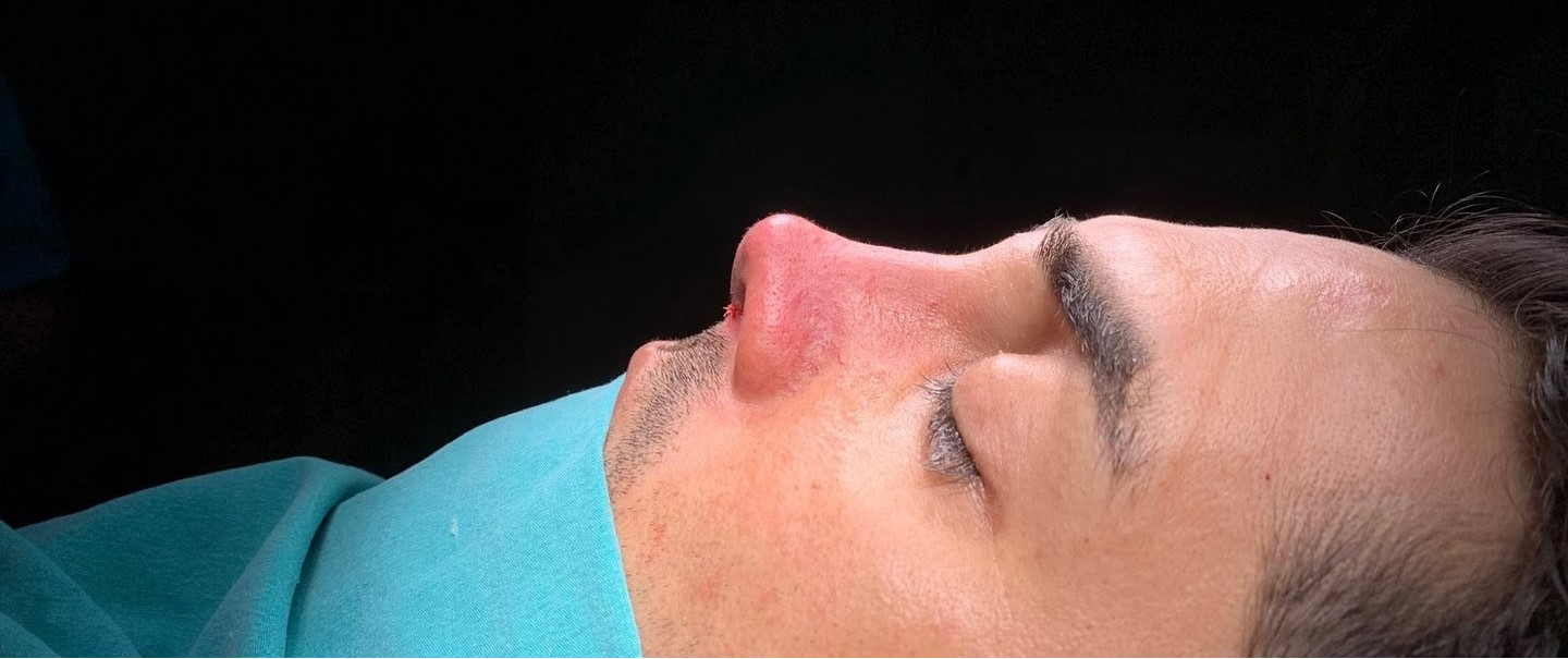Después Rinoplastia
