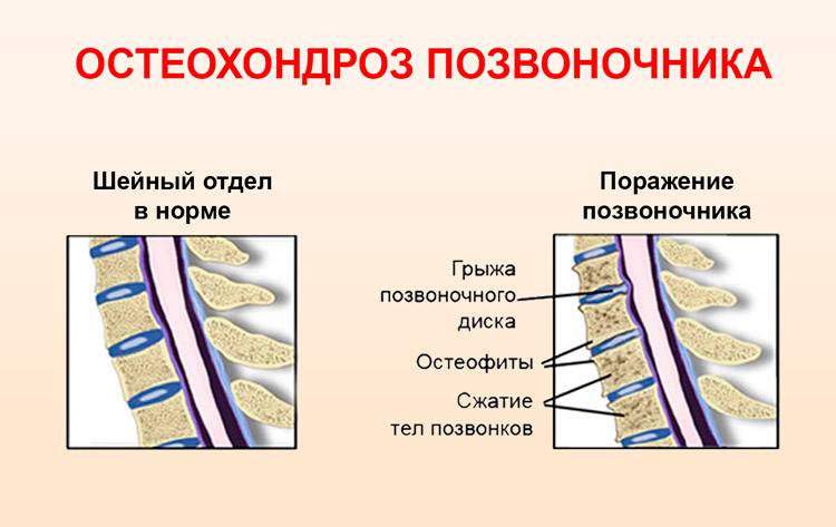 Лечение остеохондроза грудного и шейного отдела позвоночника. Грудной остеохондроз. Дистония шейного отдела позвоночника. Остеохондроз шейного отдела и ВСД. Симптомы остеохондроза шейного отдела позвоночника.