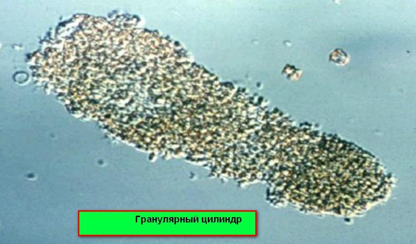 Цилиндры в моче фото под микроскопом