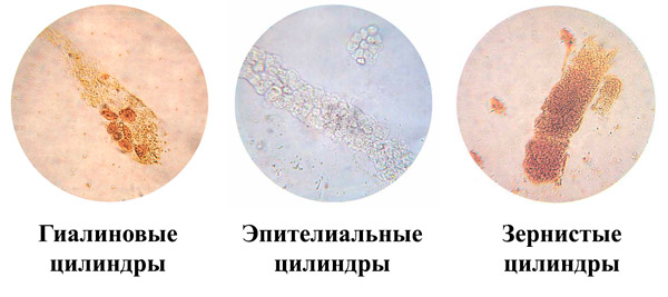 Зернистый цилиндр в моче фото