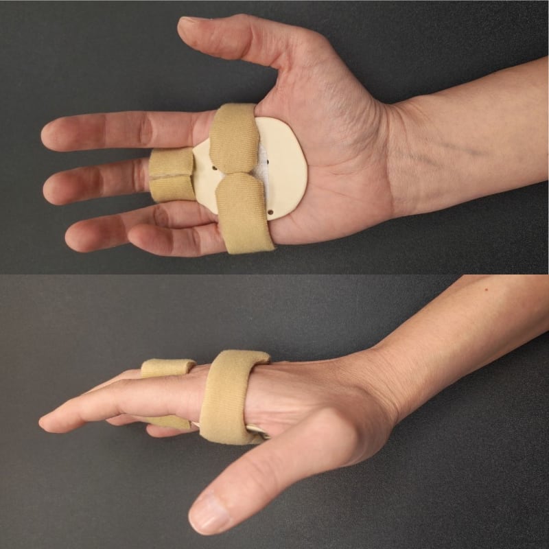Hand based MCP joint extension orthosis for a middle finger sagittal band rupture, shown from the palm and from the side.